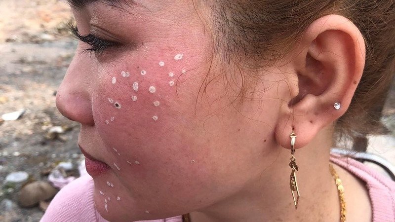 Alt cho hình ảnh quy trình chấm tàn nhang trên da mặt, thể hiện sự cẩn trọng và chính xác khi áp dụng dung dịch chuyên biệt để loại bỏ đốm sắc tố.