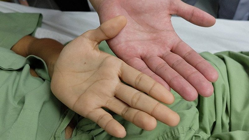 Ảnh minh họa nguy cơ viêm gan A từ việc sử dụng nước nhiễm phèn trong sinh hoạt và ăn uống, ảnh hưởng trực tiếp đến sức khỏe gan và cơ thể.