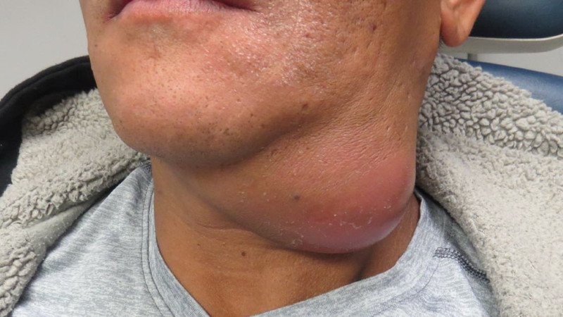 Áp xe cổ: Biến chứng nguy hiểm cần lưu ý