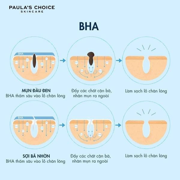 Biểu đồ mô phỏng cơ chế Salicylic Acid thâm nhập và làm sạch lỗ chân lông.