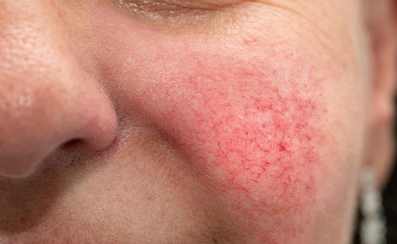 Biểu hiện da nhiễm corticoid thay đổi theo từng mức độ nặng nhẹ