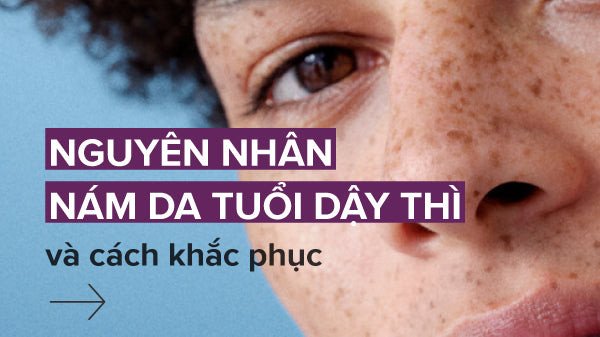 Biểu hiện nám da sớm ở lứa tuổi thanh thiếu niên, cần nhận biết nguyên nhân nám da tuổi dậy thì.