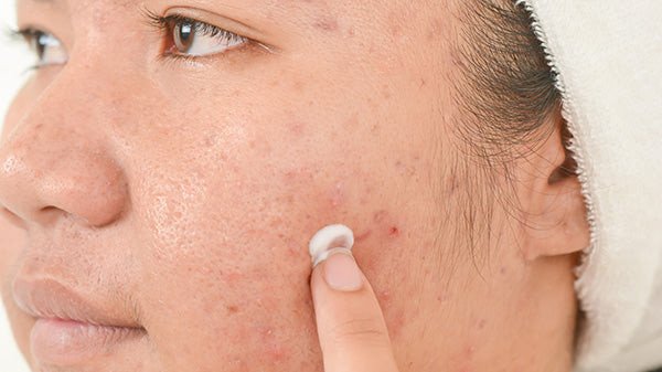 Biểu tượng các thành phần nên có và nên tránh khi chọn sản phẩm cho da khô mụn