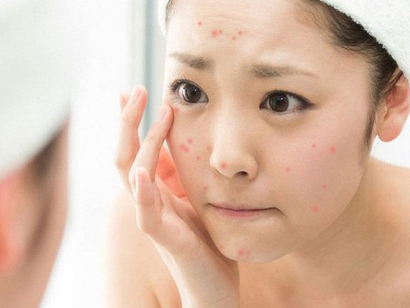 Bộ sản phẩm dưỡng da cần thiết cho chu trình chăm sóc da sau mụn