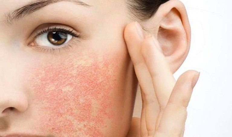 Bơ tự nhiên giúp làm dịu da và giảm viêm da rát da