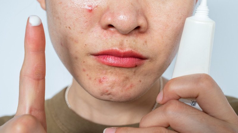Các hoạt chất Retinol và Tretinoin điều trị mụn