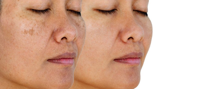 Các sản phẩm chăm sóc da chứa Tranexamic acid và Vitamin C