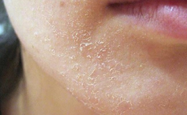 cách khắc phục tình trạng da bị bong tróc khi dùng BHA hiệu quả