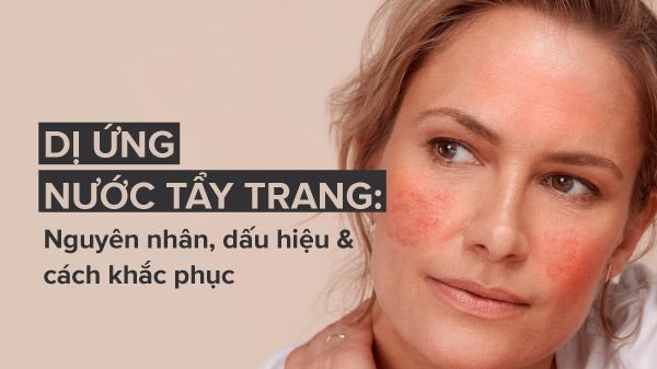 Cách nhận biết và khắc phục dị ứng nước tẩy trang hiệu quả