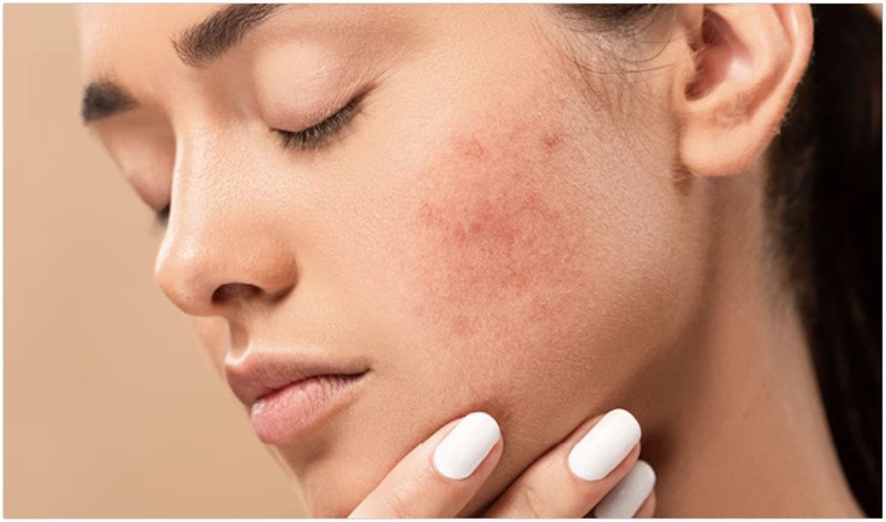 Cần lưu ý các dấu hiệu kích ứng da khi trị mụn bằng bột đậu đỏ
