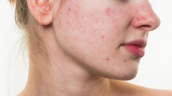 Chế độ dinh dưỡng và lối sống lành mạnh cho da mụn bà bầu