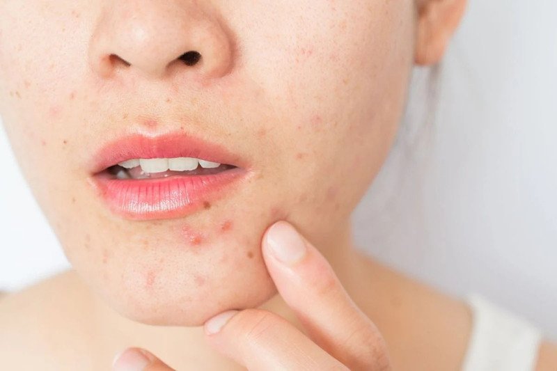 Chuyên gia da liễu phân tích liệu mụn viêm có nên dùng BHA để điều trị
