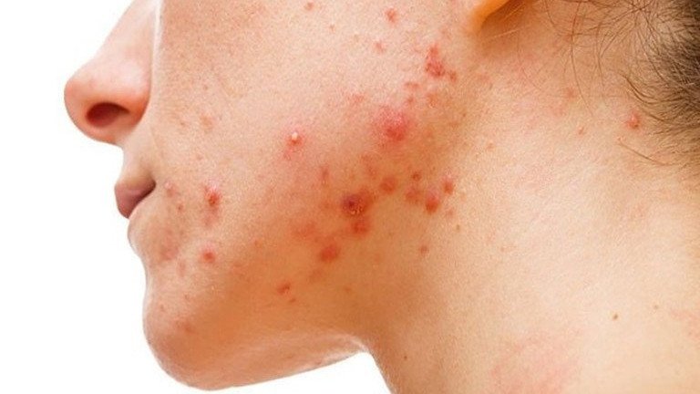 Cơ chế hoạt động của Axit Azelaic trong Megaduo giảm mụn