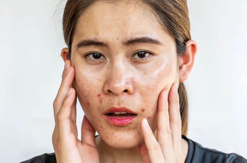 Cô gái trẻ với làn da dầu mụn, biểu cảm lo lắng về tình trạng da, minh họa sự mất tự tin do mụn