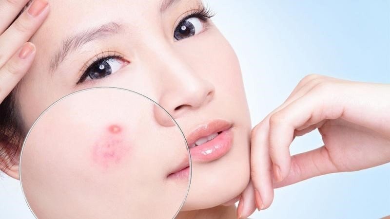 Công dụng của BHA đối với làn da, làm sạch sâu lỗ chân lông và ngăn ngừa mụn hiệu quả