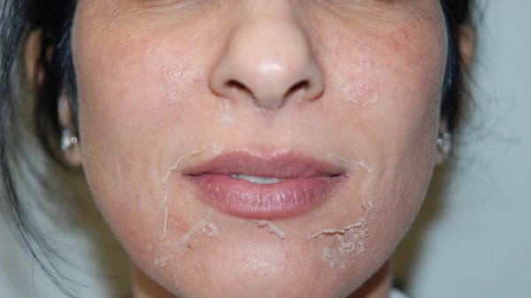 Da bị bong tróc sau khi peel, cần đắp mặt nạ