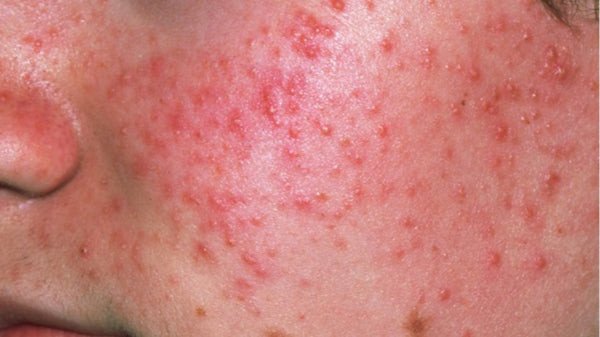 Da bị kích ứng mẩn đỏ do chăm sóc sai cách sau khi peel da