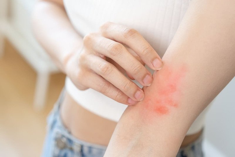 Da bị mẩn đỏ và ngứa ngáy do dùng sữa tắm Hatomugi giả kém chất lượng