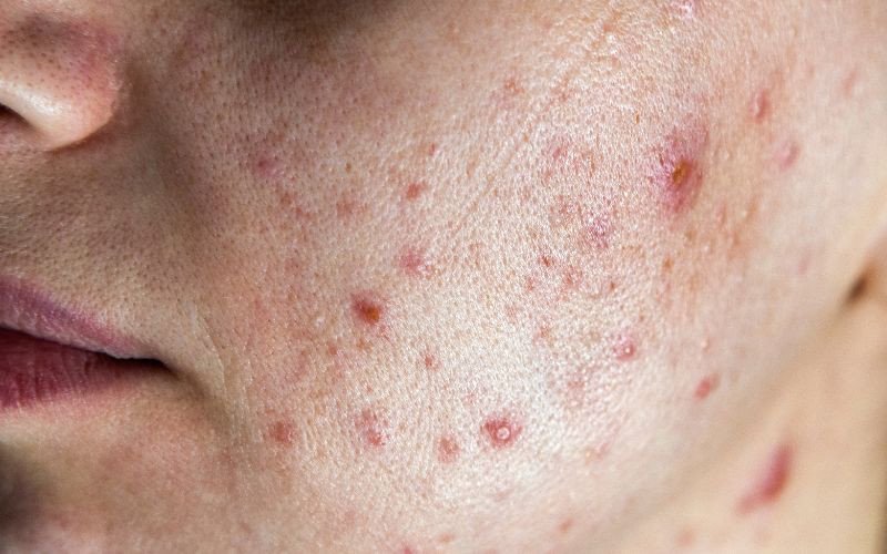 Da bị mụn và kích ứng do sử dụng mỹ phẩm hết hạn