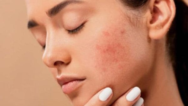 Da bong tróc và nổi mụn nhẹ là phản ứng bình thường của làn da sau khi peel