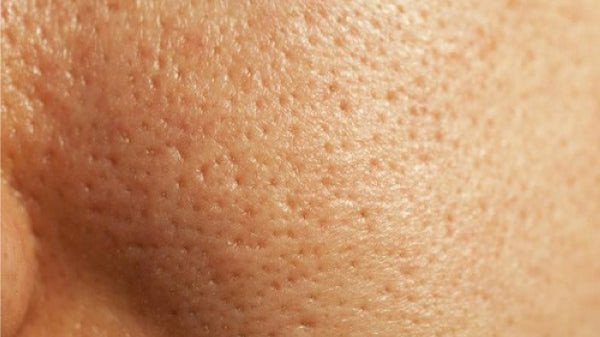Da dầu và lỗ chân lông to thường đi kèm với vấn đề mụn