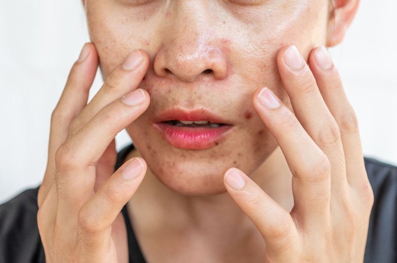 da mặt bóng dầu cần được làm sạch sâu bằng sữa rửa mặt