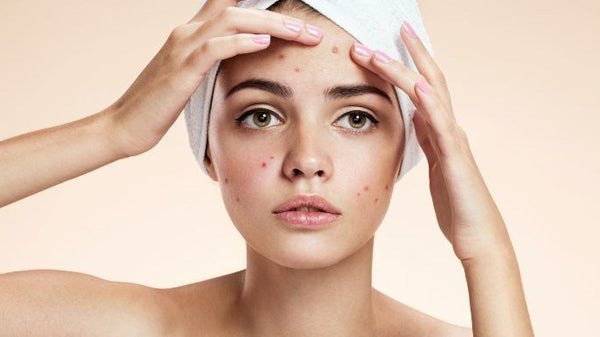 Da mặt xuất hiện mụn đỏ, minh họa tác dụng phụ khi sử dụng kem dưỡng ẩm sai cách