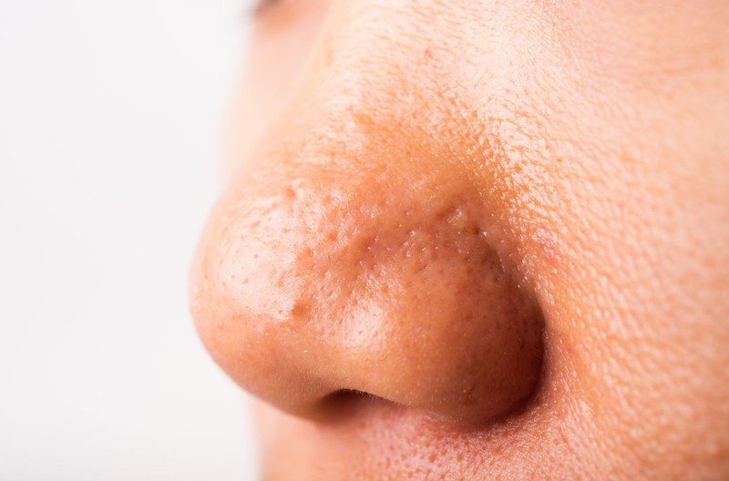 Đặc điểm làn da dầu nhờn với lỗ chân lông to