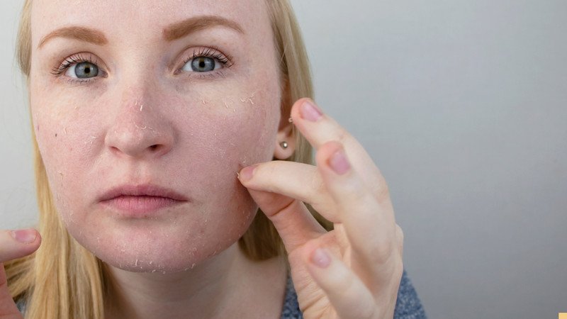 Dấu hiệu nhận biết da khô dễ bong tróc và sần sùi
