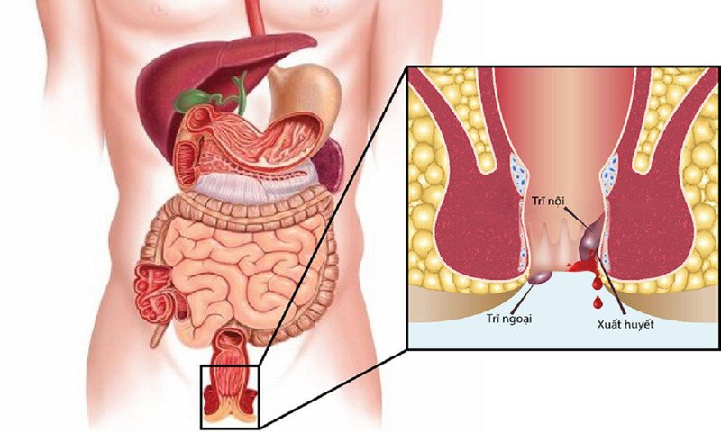 Dấu hiệu xuất huyết hậu môn không đau cảnh báo vấn đề tiêu hóa