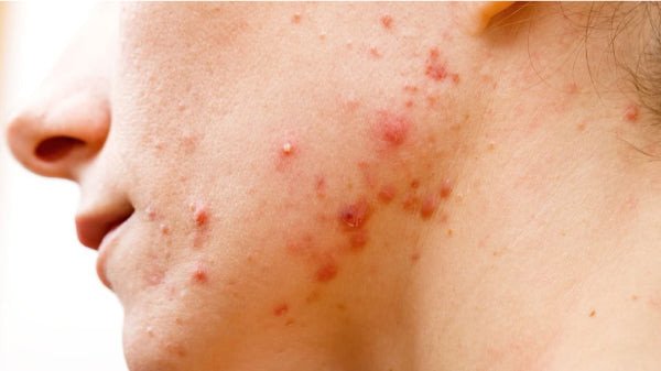 Dị ứng nước tẩy trang gây nổi mụn trên da mặt