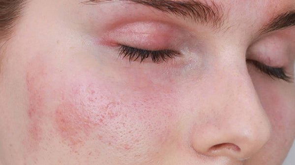 Gương mặt phụ nữ nổi mẩn đỏ, biểu hiện da bị kích ứng và rát khi dùng kem dưỡng ẩm