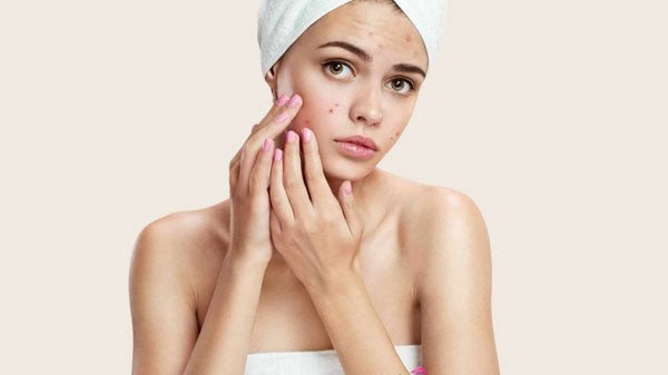 Hạn chế chạm tay lên mặt để phòng ngừa mụn đầu đen lây lan
