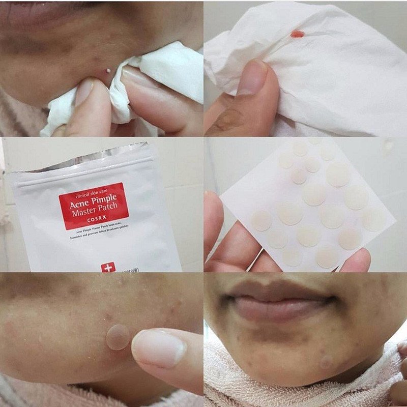 Hiệu quả giảm sưng của miếng dán mụn Cosrx