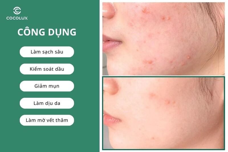 Hiệu quả làm sạch và giảm mụn của sữa rửa mặt Some By Mi Acne