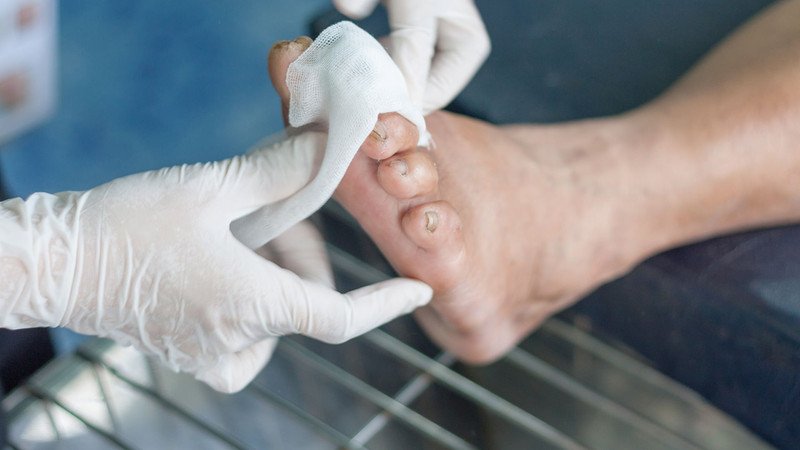Hình ảnh bàn chân bị loét do biến chứng tiểu đường cho thấy tầm quan trọng của việc kiểm soát toàn diện