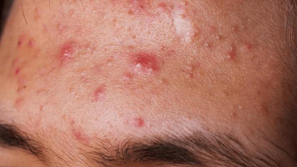 Hình ảnh cận cảnh làn da với mụn trứng cá và mụn đầu đen