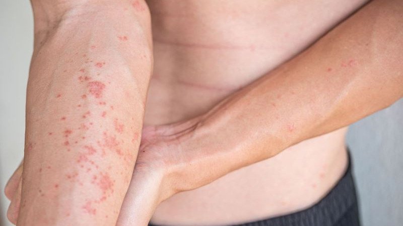 Hình ảnh da bị kích ứng, mẩn đỏ do tiếp xúc lâu dài với nước nhiễm phèn, minh họa tác động tiêu cực đến sức khỏe làn da và tóc.
