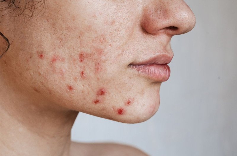 Hình ảnh minh họa tầm quan trọng của sữa rửa mặt trong quy trình chăm sóc da mụn