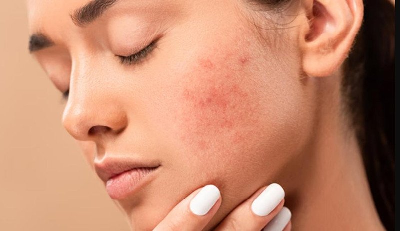 Hình ảnh mô tả da mặt nhạy cảm bị nổi mụn khi dùng sữa rửa mặt không phù hợp