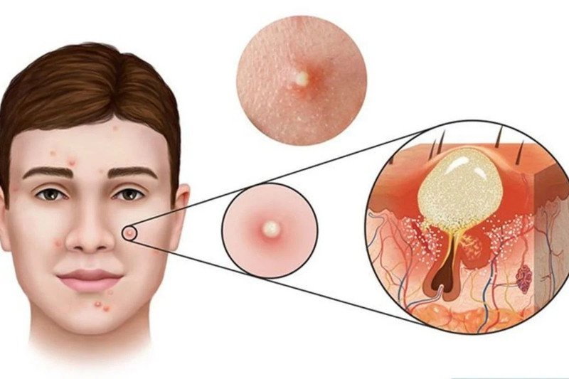 Hình ảnh trực quan về nốt mụn viêm sưng đỏ, giúp nhận biết mụn viêm có nên dùng BHA