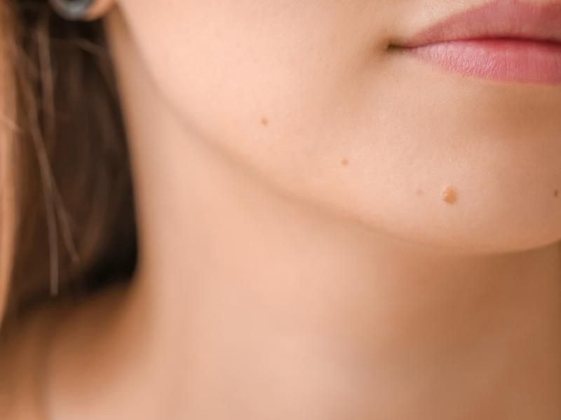Hướng dẫn chăm sóc da đúng cách sau khi tẩy nốt ruồi giúp da phục hồi nhanh chóng