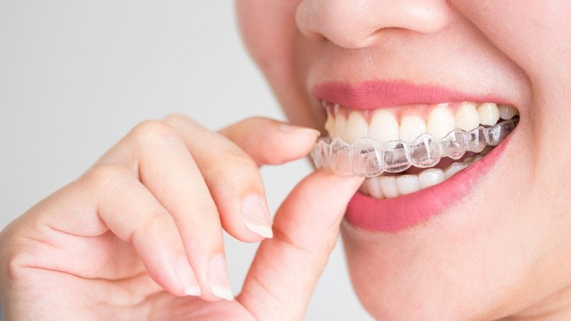 Invisalign là phương pháp chỉnh nha không mắc cài, sử dụng hệ thống khay niềng bằng nhựa y tế trong suốt