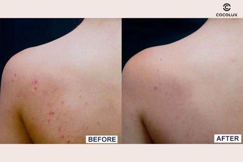 Kết quả thực tế sau khi sử dụng Gel Rửa Mặt La Roche-Posay Effaclar Giảm Mụn