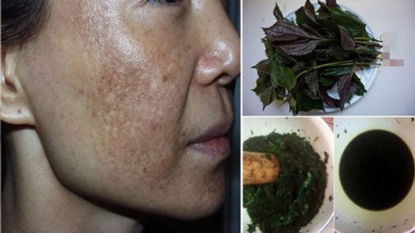 Lá tía tô tươi chứa nhiều dưỡng chất quý giá cho làn da trị nám