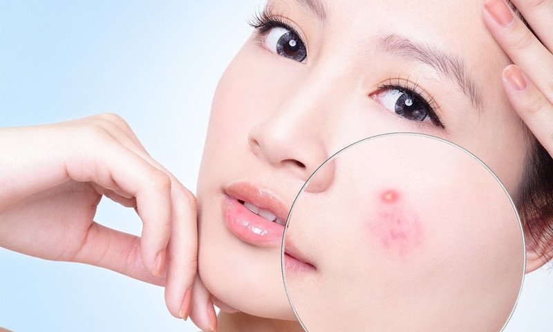 Lá trầu không hỗ trợ giảm mụn trứng cá viêm hiệu quả