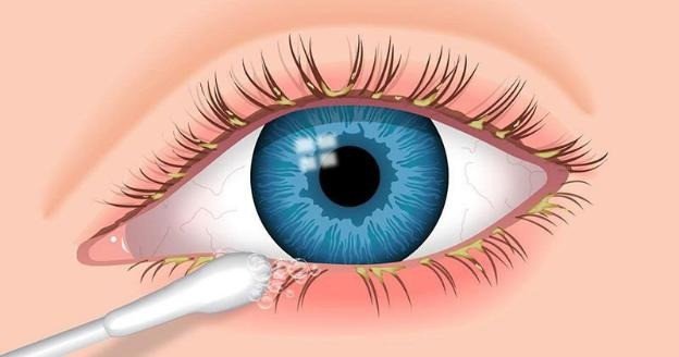 Làm sạch ghèn và chất nhầy ở mắt bằng tăm bông an toàn