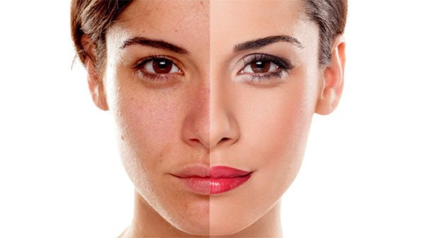 Làn da mịn màng, rạng rỡ sau khi peel da, thể hiện công dụng của peel da tại nhà