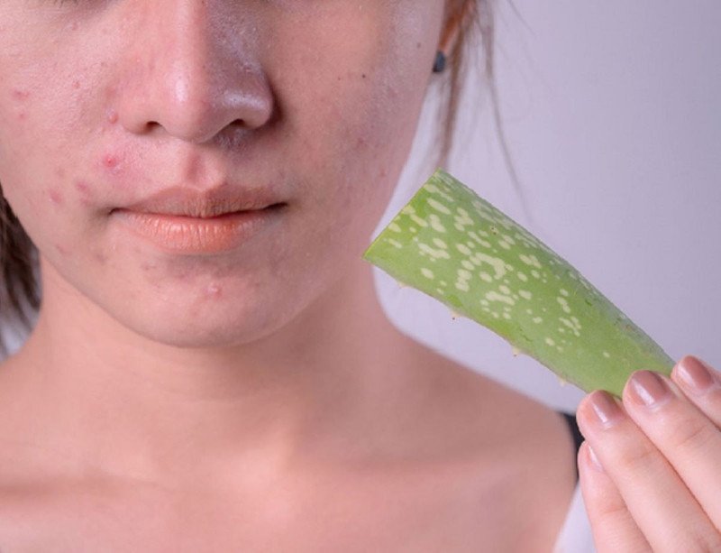 Lợi ích nha đam làm dịu mụn và se khít lỗ chân lông