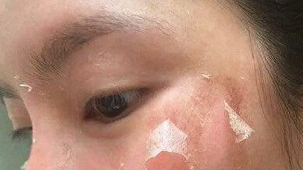 Lưu ý chăm sóc da khoa học giúp giảm thiểu tác dụng phụ sau khi peel da